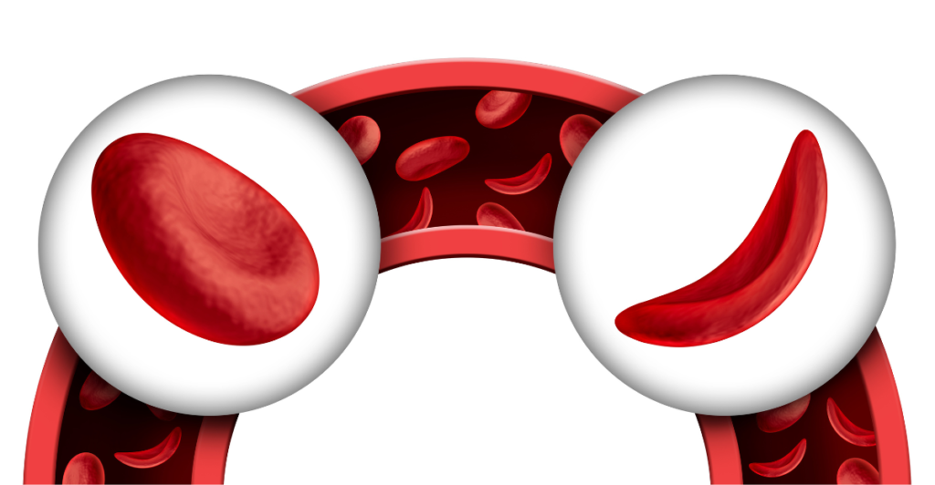 Ilustração de uma corrente sanguínea com glóbulos vermelhos normais e glóbulos em forma de foice ou meia-lua, como descreve na doença de sangue Anemia Falciforme.